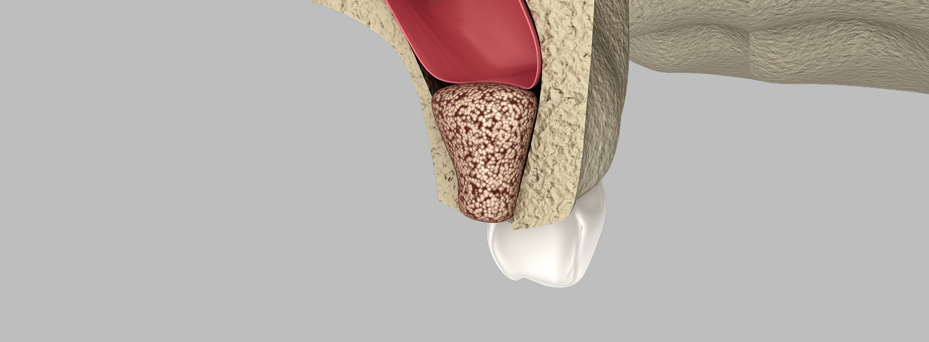 Dental Implants Dentist in San Jose